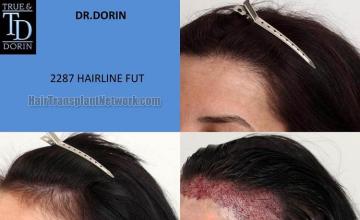 Hair restoration procedure before and after pictures