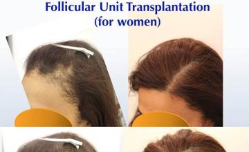 Female hair restoration surgical procedure before and after pictures