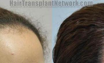 Female hair transplantation surgery before and after images