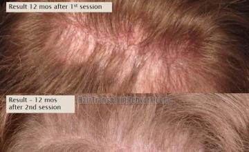 Hair transplantation surgery before and after images