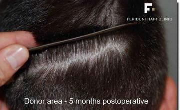 Hair restoration procedure results