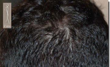 Hair restoration procedure results