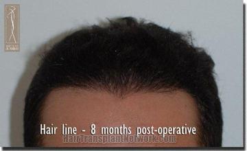 Hair restoration procedure results