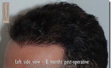 Hair restoration procedure results