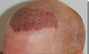 Hair restoration procedure results