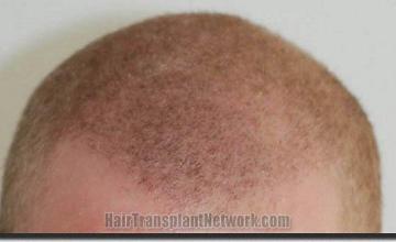 Hair restoration procedure results