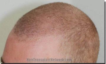 Hair restoration procedure results