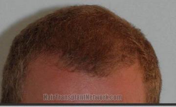 Hair restoration procedure results