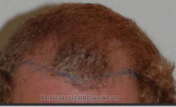 Hair restoration procedure results