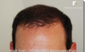 Hair restoration procedure results