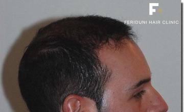 Hair restoration procedure results