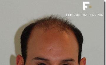 Hair restoration procedure results