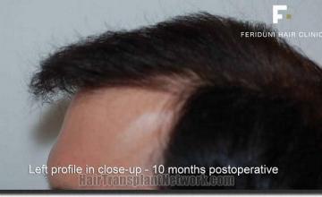 Hair restoration procedure results