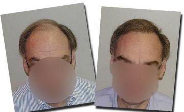 Hair restoration procedure results