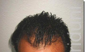 Hair restoration procedure results