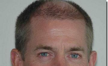 Hair restoration procedure results