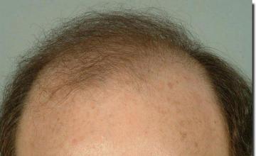 Hair restoration procedure results