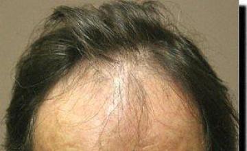 Hair restoration procedure results