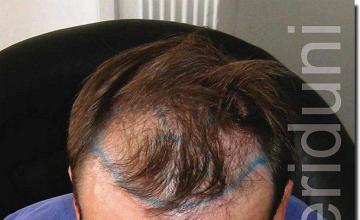 Hair restoration procedure results