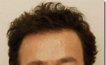 Hair restoration procedure results