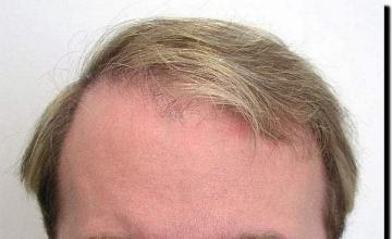 Hair restoration procedure results