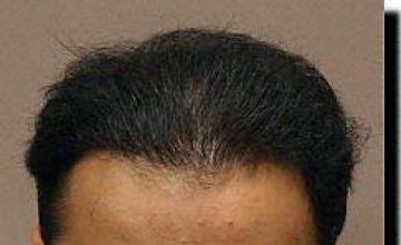 Hair restoration procedure results