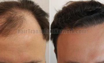 Frontal area before and after surgery 