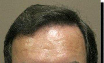 Hair restoration procedure results