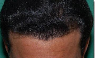 Hair restoration procedure results