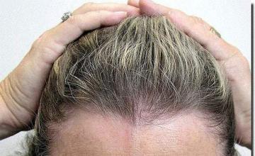 Hair restoration procedure results