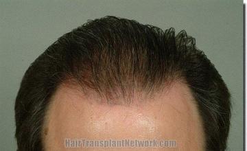 Hair restoration procedure results