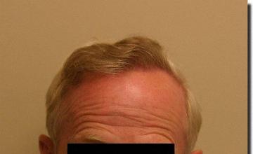 Hair restoration procedure results