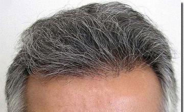 Hair restoration procedure results