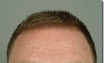 Hair restoration procedure results