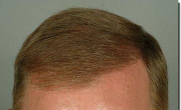 Hair restoration procedure results