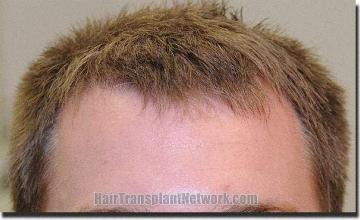 Hair restoration procedure results