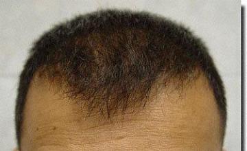 Hair restoration procedure results