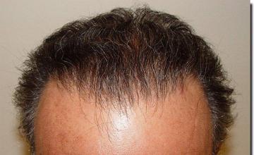 Hair restoration procedure results