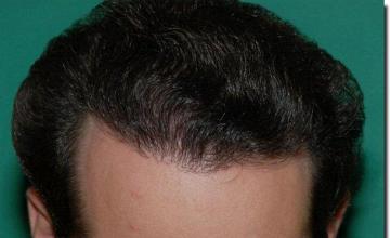 Hair restoration procedure results