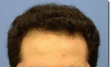 Hair restoration procedure results