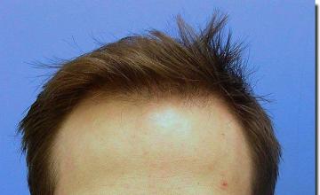 Hair restoration procedure results