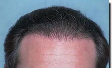 Hair restoration procedure results