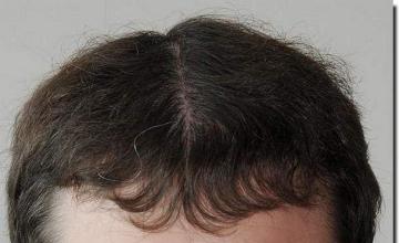 Hair restoration procedure results