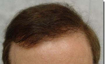 Hair restoration procedure results