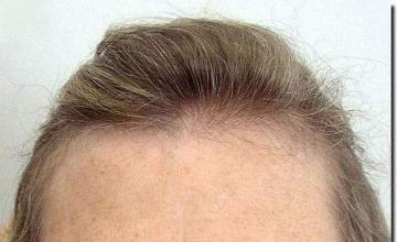 Hair restoration procedure results