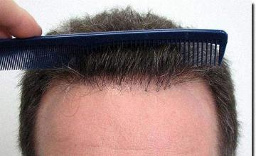 Hair restoration procedure results