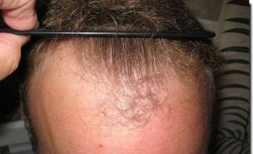 Hair restoration procedure results