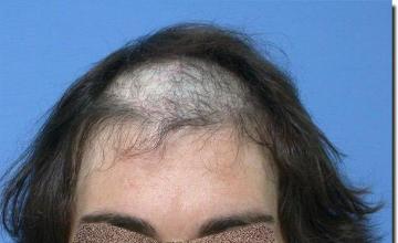 Hair restoration procedure results