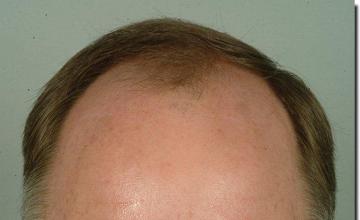 Hair restoration procedure results