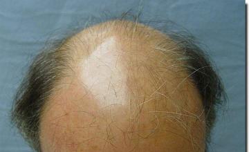 Hair restoration procedure results